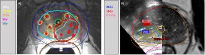 MRI-guided focal or integrated boost high dose rate brachytherapy for recurrent prostate cancer